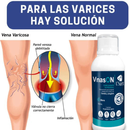 VNAS ON - Tratamiento Avanzado para Várices